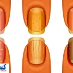تشخیص سرطان ریه از روی ناخن ممکن شد